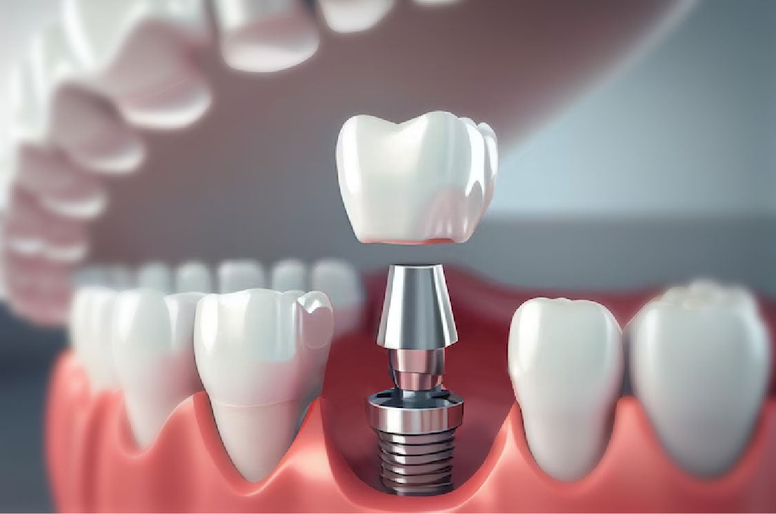 the-rising-demand-of-dental-implants-in-india-dentistfirst